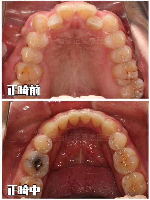 梦见掉牙三个破解方法（梦见掉牙三个破解方法解梦梦见牙齿松动一拔就掉了）